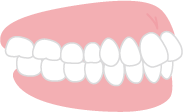 出っ歯の歯並び