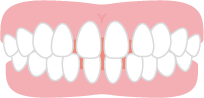 すきっ歯の歯並び