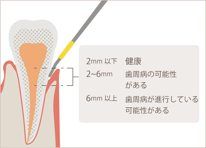 歯周ポケット検査ではポケットの深さが2mm以下なら健康、2〜6mmなら歯周病の可能性、6mm以上の場合歯周病が進行している可能性があると診断