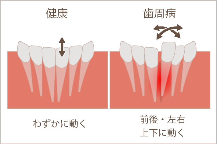 健康場合歯はわずかに動く、歯周病の場合歯が前後左右上下に動く