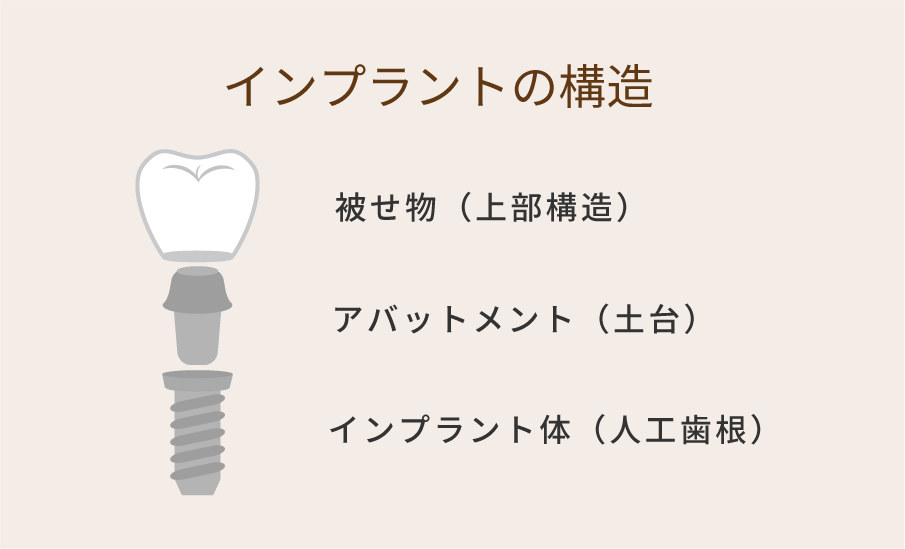 インプラントの構造は、被せ物(上部構造)とアバットメント(土台)とインプラント体(人工歯根)からなる