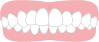 噛み合わせが深い歯並び