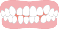 でこぼこの歯並び