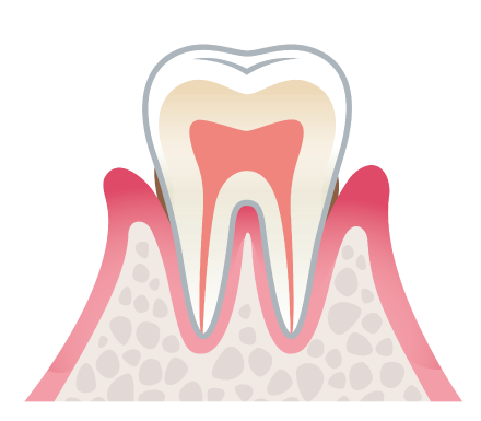 軽度歯周炎