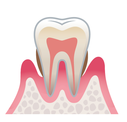 中度歯周炎